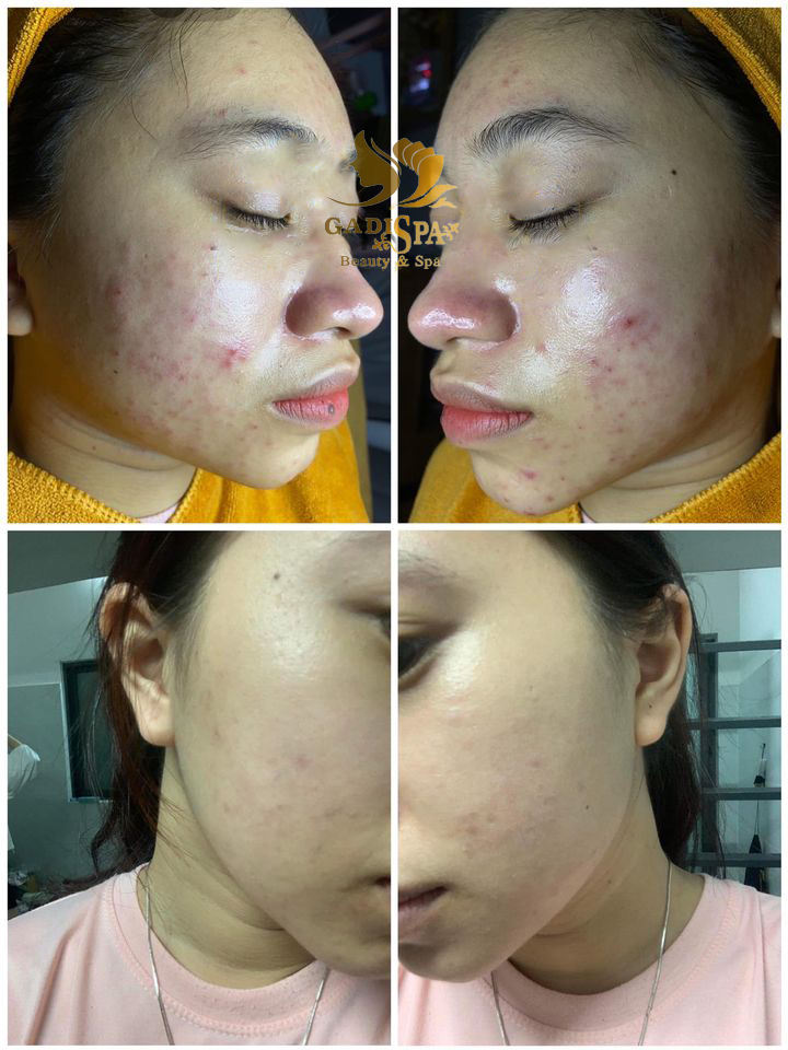 Dịch vụ điều trị mụn ra đời sử dụng các giải pháp tối ưu giúp bạn “đánh bật” mụn chỉ trong 1 liệu trình.
