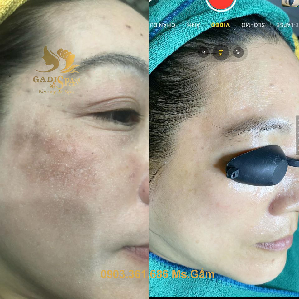 Dịch vụ điều trị nám da - Tình trạng nám da ảnh hưởng rất nhiều đến thẩm mỹ vì vậy nhiều chị em luôn thấy tự ti về vẻ ngoài của mình.