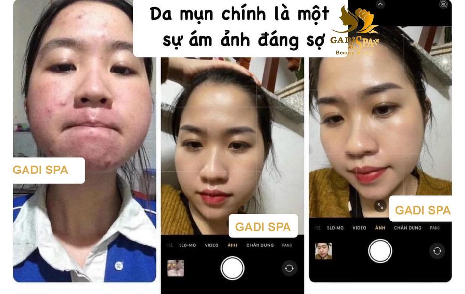 Dịch vụ điều trị mụn ra đời sử dụng các giải pháp tối ưu giúp bạn “đánh bật” mụn chỉ trong 1 liệu trình.