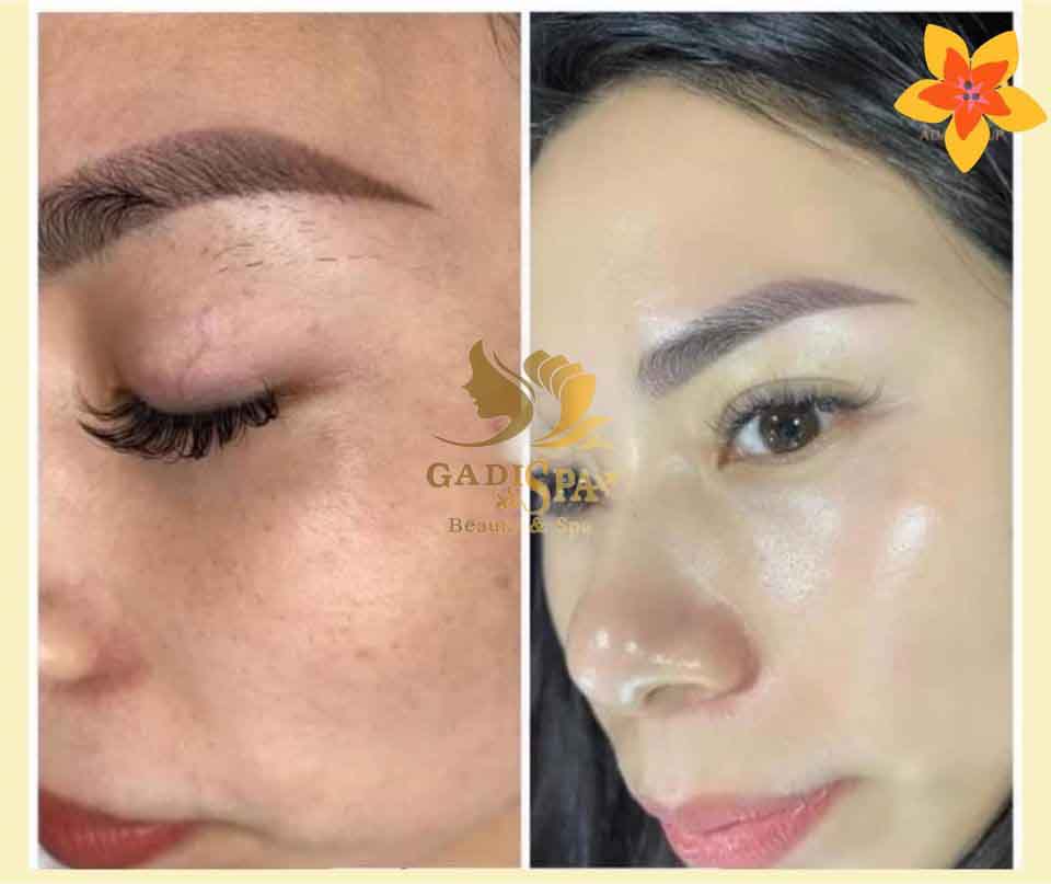Dịch vụ điều trị nám da - Tình trạng nám da ảnh hưởng rất nhiều đến thẩm mỹ vì vậy nhiều chị em luôn thấy tự ti về vẻ ngoài của mình.