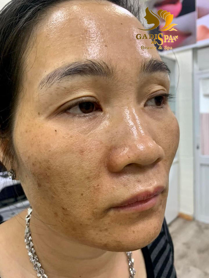 Nếu bạn đang tìm kiếm dịch vụ hỗ trợ điều trị tàn nhàng, đồi mồi tận gốc thì Spa chuyên trị nám Quận 12 sẽ là sự lựa chọn tốt nhất dành cho bạn.