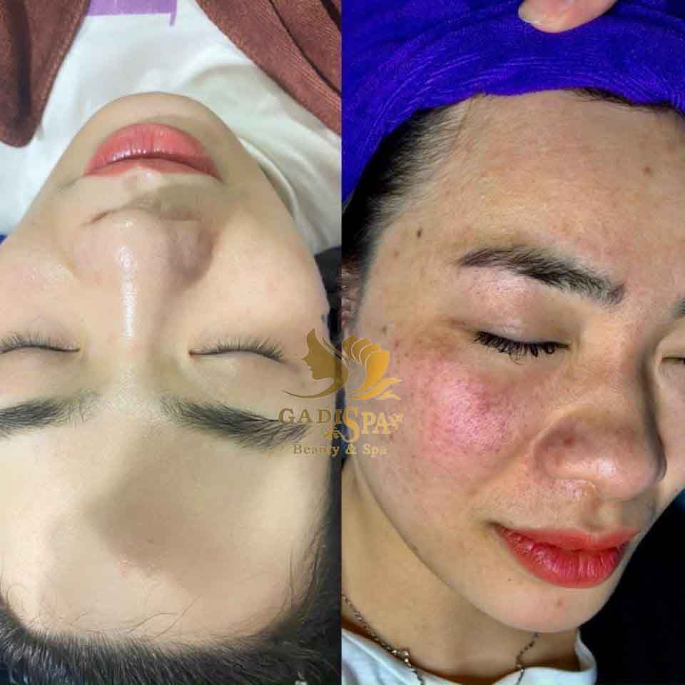 Dịch vụ điều trị nám da - Tình trạng nám da ảnh hưởng rất nhiều đến thẩm mỹ vì vậy nhiều chị em luôn thấy tự ti về vẻ ngoài của mình.