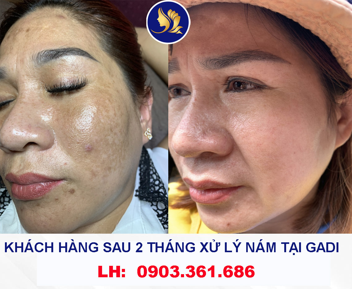 Giải pháp điều trị nám da bằng laser công nghệ cao đang được nhiều người quan tâm.Trị nám ở đâu tốt tphcm