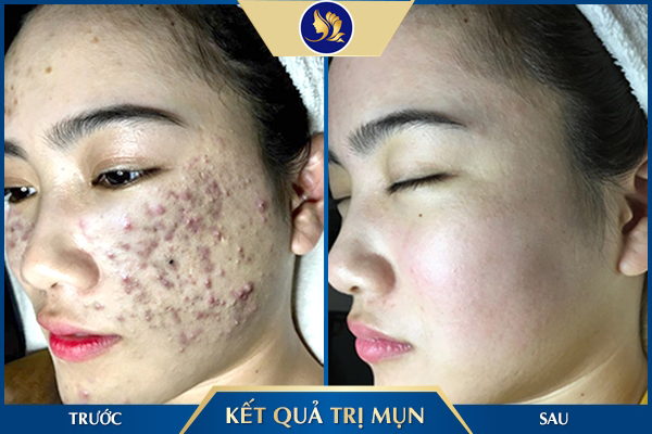 Dịch vụ điều trị mụn - Mụn chính là nỗi ám ảnh của rất nhiều người bởi tình trạng này có thể gây nhiều tổn thương cho da và khiến cho khuôn mặt mất đi sự xinh đẹp.