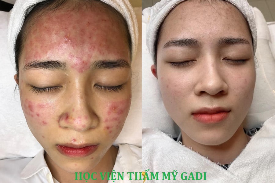 Spa Điều Trị Mụn Uy Tín Quận 12 - Lấy nhân mụn ở đâu tốt, đảm bảo uy tín và chất lượng tại TP. HCM là chủ đề đang được khá nhiều người quan tâm