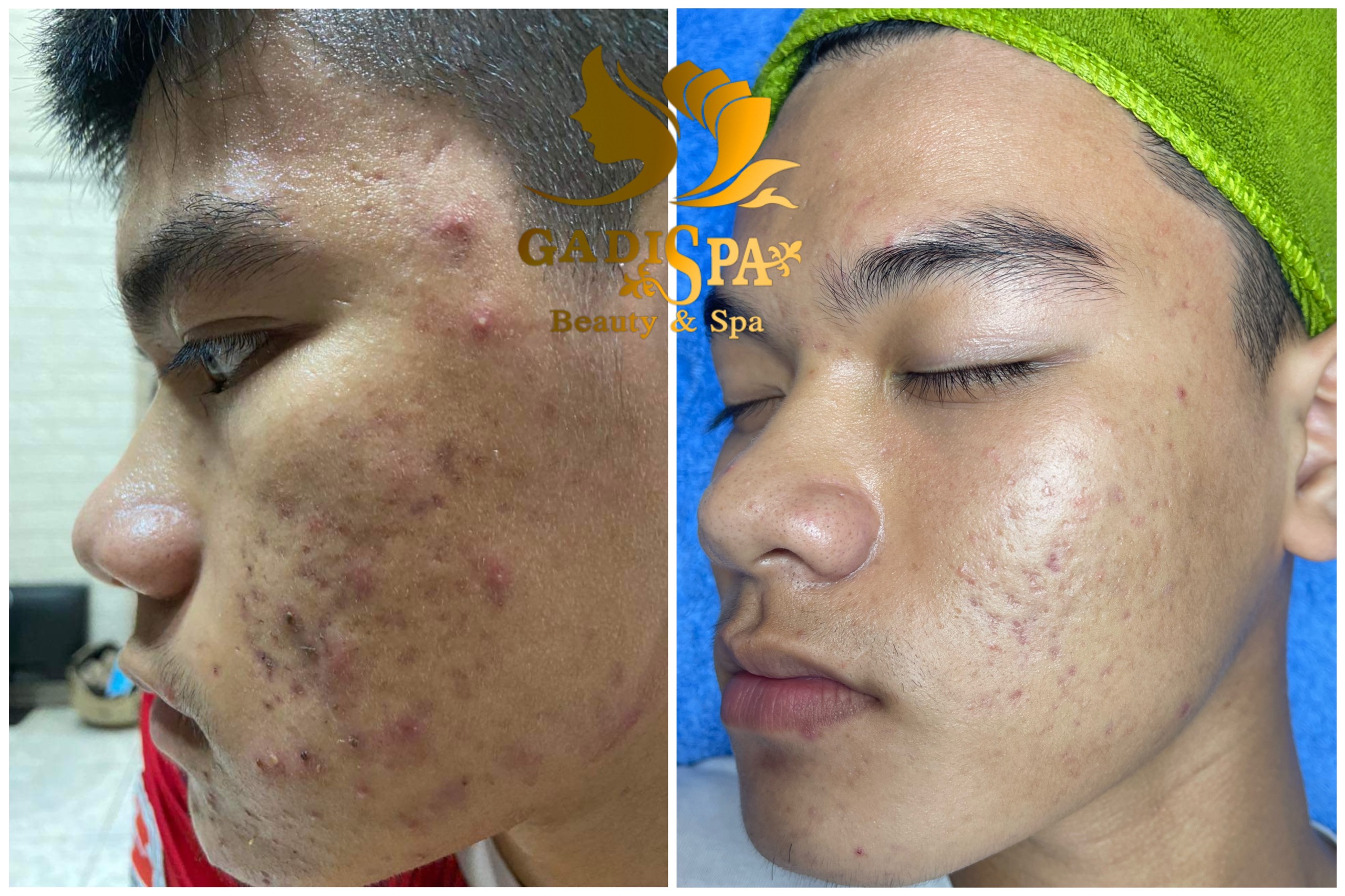 Spa trị mụn quận 12 tphcm - Để có thể làm mờ hoàn toàn những nốt mụn xấu xí trên da, phái đẹp đã lựa chọn dịch vụ lấy nhân mụn tại những thẩm mỹ viện uy tín.
