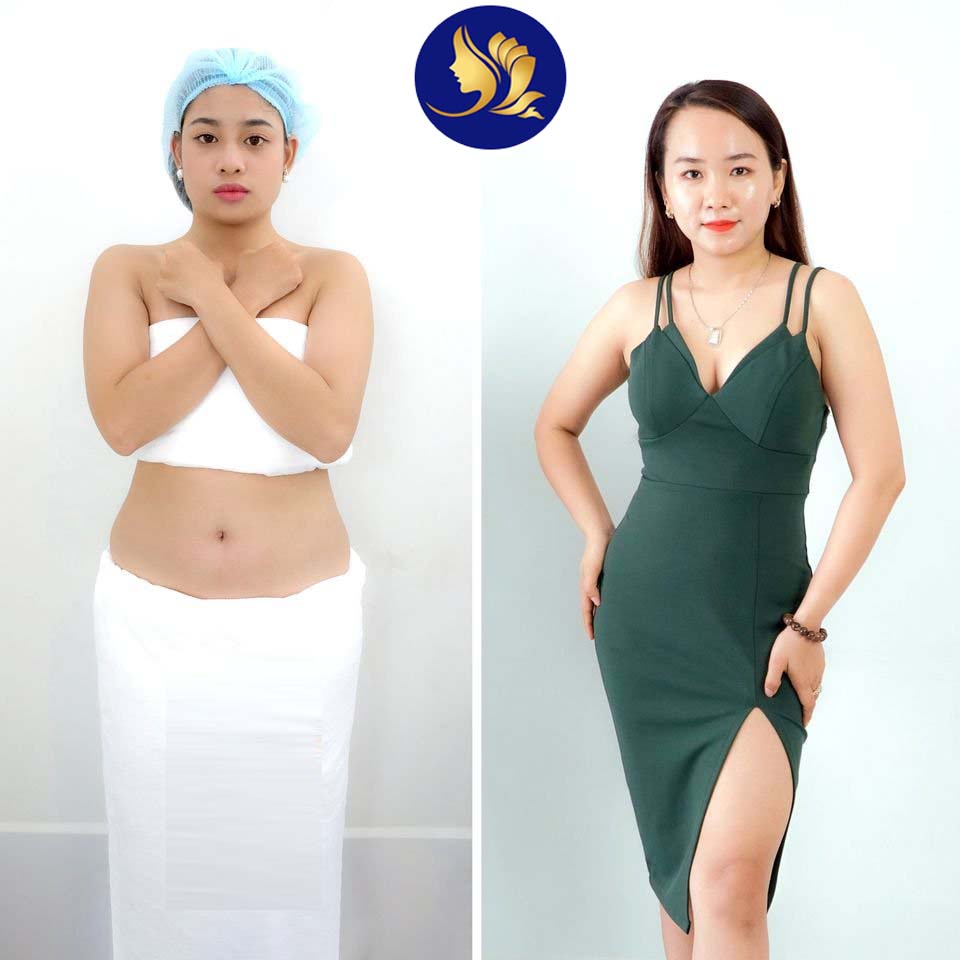 Ưu điểm tuyệt vời về công nghệ giảm mỡ bụng tại Spa Giảm Mỡ Bụng Uy Tín Tại Hồ Chí Minh Giảm Mỡ Bụng Uy Tín Tại Hồ Chí Minh