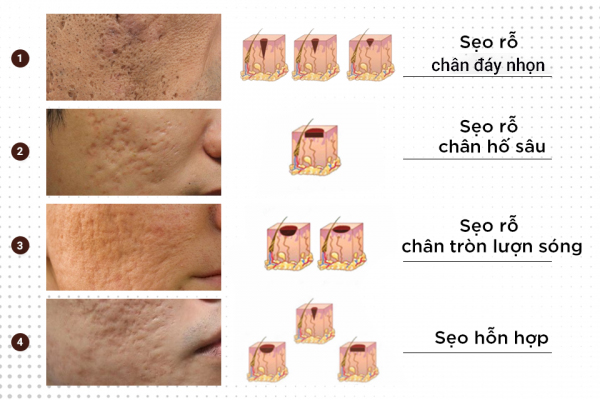 Vì vậy, khi bị sẹo cần chữa trị càng sớm càng tốt để tiết kiệm chi phí cũng như thời gian, công sức và hiệu quả điều trị sẽ cao hơn. Địa Chỉ Trị Sẹo Rỗ Tại Quận 12 TPHCM