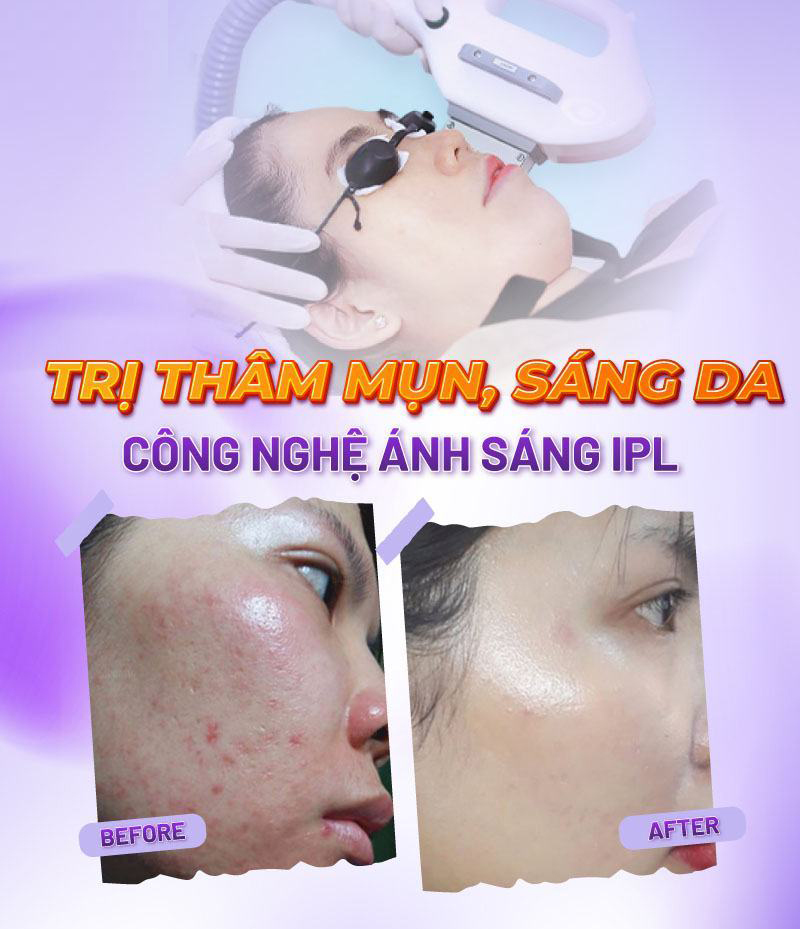 Spa trị thâm mụn hiệu quả Quận 12 - Những vết thâm mụn sẽ là nỗi ám ảnh của nhiều người, những vết thâm mụn sẽ khiến da trở nên không đều màu, kém sắc
