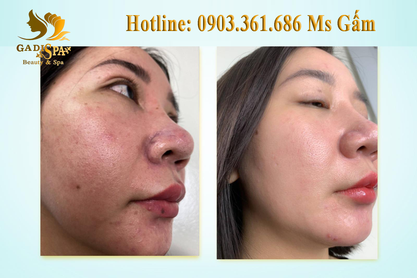 ĐÂU MỚI LÀ PHƯƠNG PHÁP TRỊ SẸO RỖ TỐT NHẤT? Địa Chỉ Trị Sẹo Rỗ Tại Quận 12 TPHCM