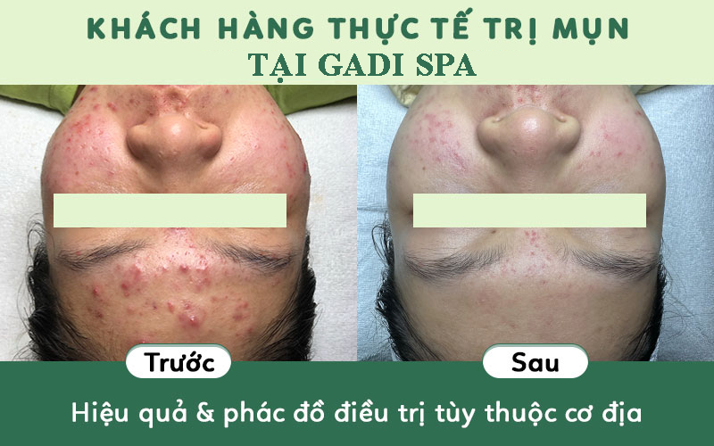 Spa lấy nhân mụn chuẩn y khoa quận 12 -quy trình nặn mụn chuẩn y khoa vô trùng và sự kết hợp giữa lấy mụn